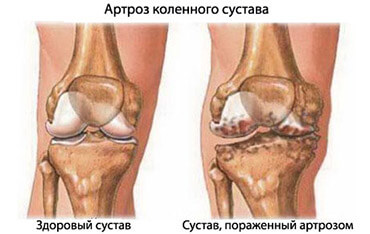 Masti za artrozu zgloba koljena, kuka, lakta i druge, vrste i indikacije za uporabu
